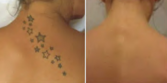 Tattooentfernung am Rücken