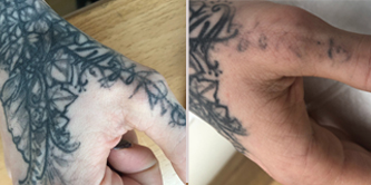 Entfernung schwarzes Tattoo am Handrücken