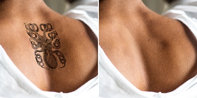 Entfernung schwarzes Tattoo Rücken