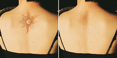 Entfernung mehrfarbiges Tattoo Rücken